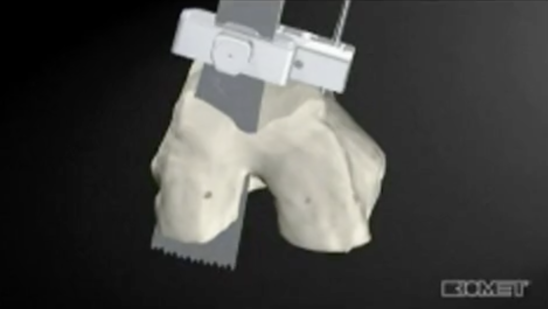 Computer modeling of a total knee replacement.
