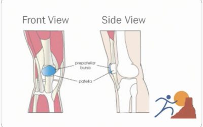 Knee Bursitis