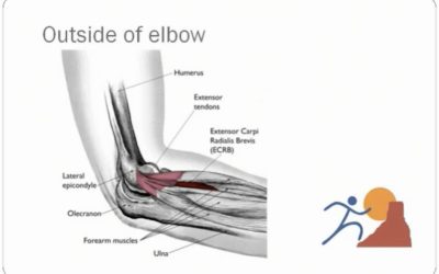 Diagnosing and Treating Tennis Elbow