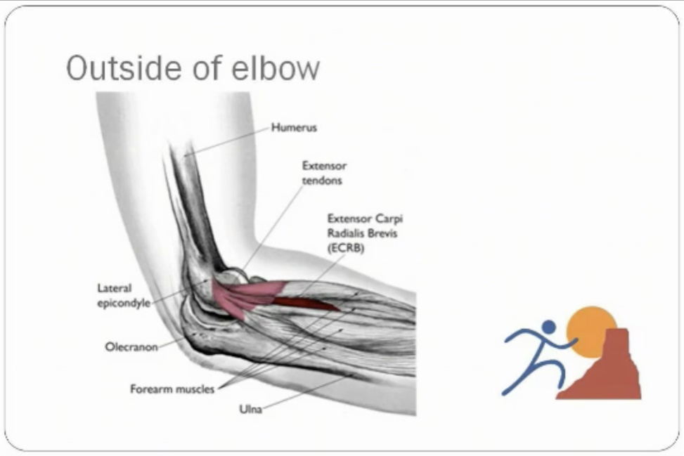 Diagnosing and Treating Tennis Elbow